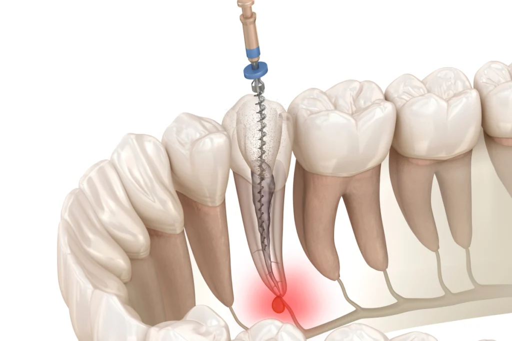 devitalisation endodontie dentaire Endodontie Dentistes à Château-Arnoux-Saint-Auban