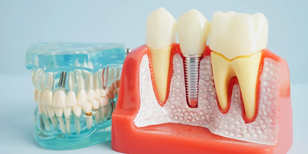 implant dentaire x Soins dentaires Cabinet dentaire NACRE - Dentistes à Saint-Jacques-de-la-Lande