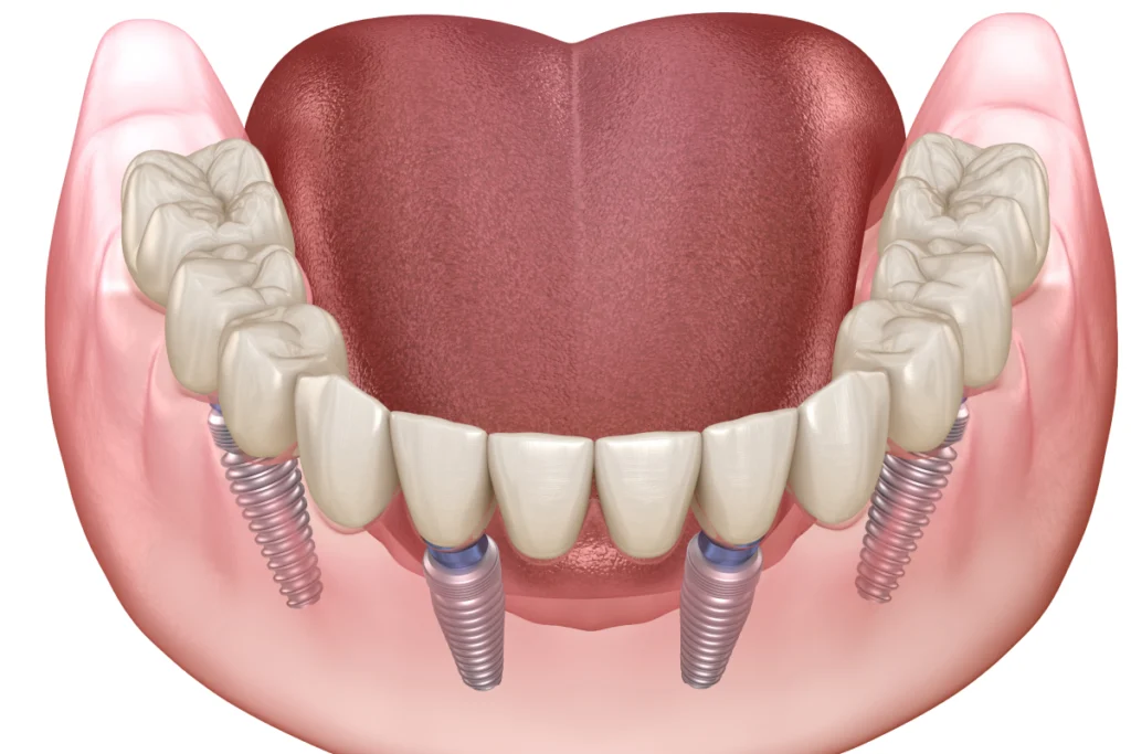 implant dentaire complet all on Implants dentaires Dentistes à Château-Arnoux-Saint-Auban